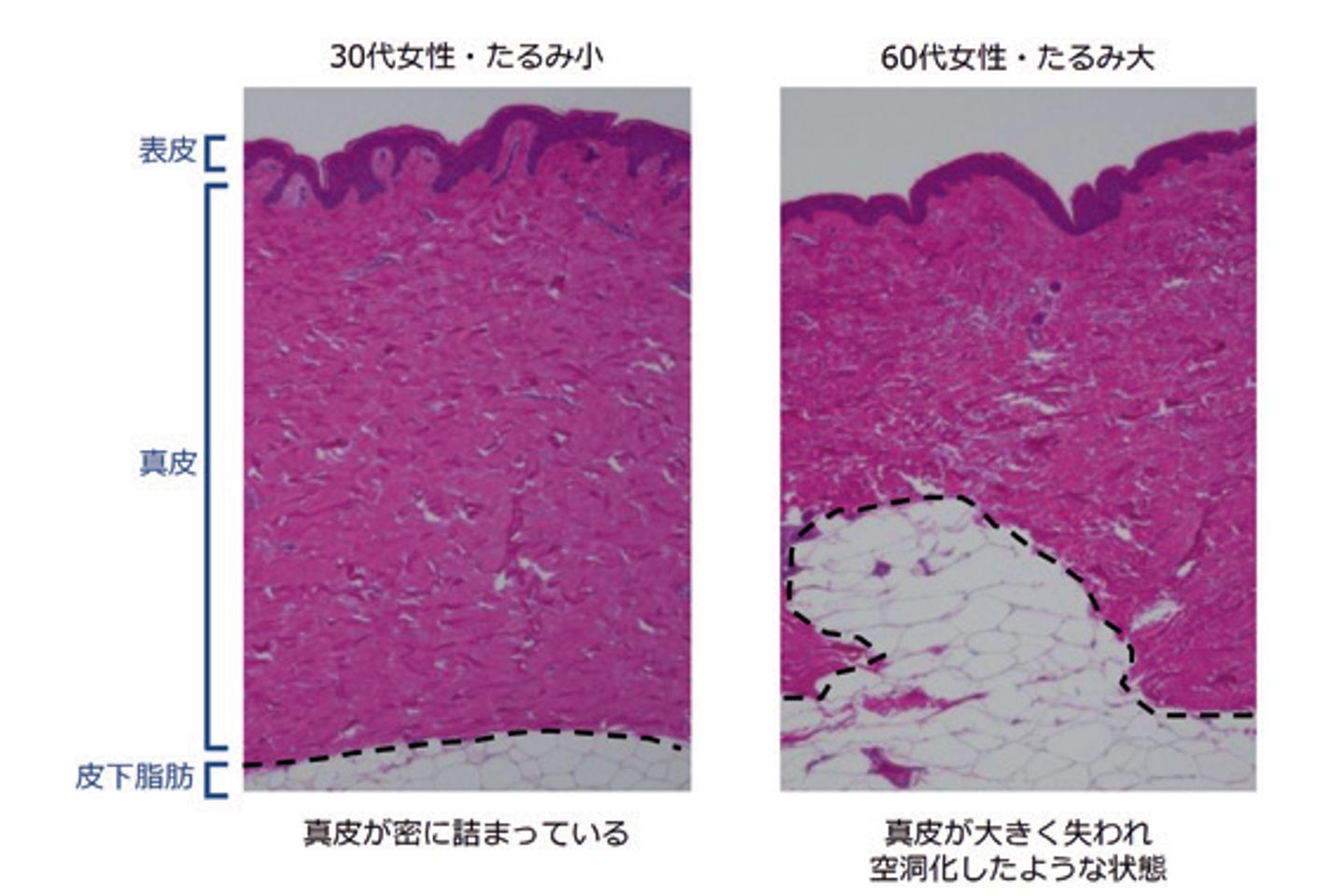 年齢とともに真皮がやせていく!
