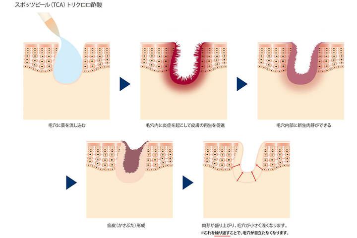 「スポッツピール」の仕組み