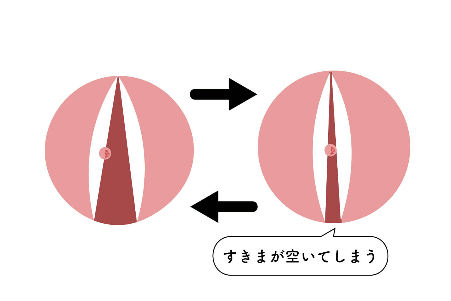 声帯の粘膜が傷つくと、2枚のヒダが閉じきらず隙間ができます