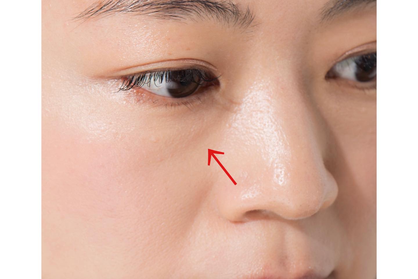 目頭下から斜め45°に伸びる影を「ゴルゴライン」と呼ぶ。