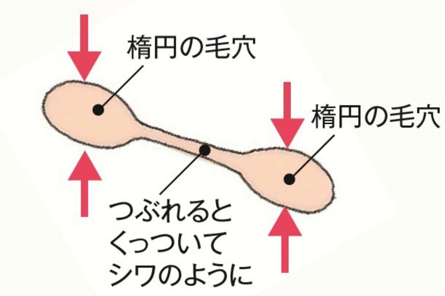 一つひとつの毛穴が大きく深い「たるみ毛穴」になり、つながって溝になると「帯状毛穴」と呼ばれる状態に